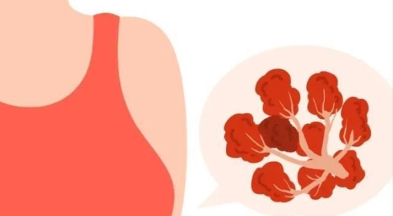 陈皮疗法：打破乳腺结节困局，排湿化痰，恢复健康