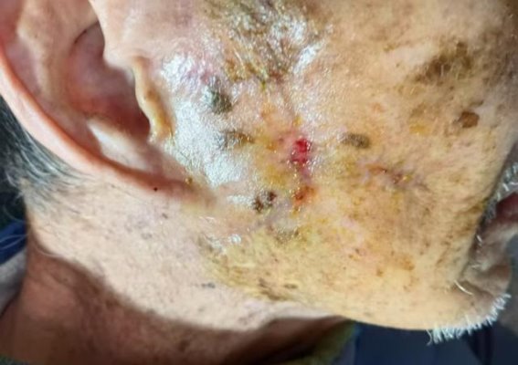 82岁老人的“拆弹”手术：从肿瘤到重生的故事