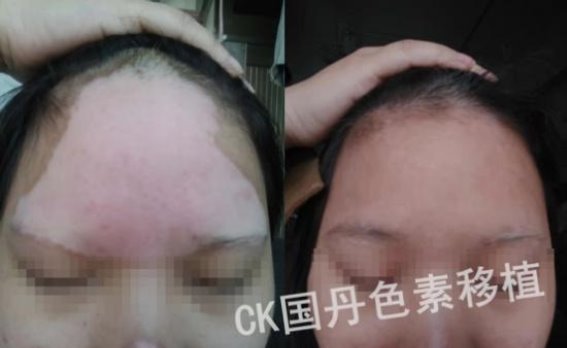 女性白癜风治疗新选择：CK-国丹色素移植为美丽加分