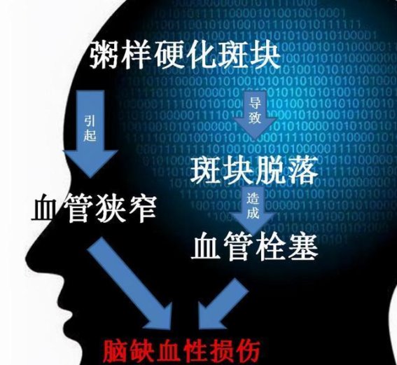 颈动脉斑块与中风的隐秘关联：如何预防与治疗