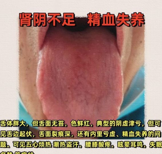 中医舌诊：脾虚、肾亏、气血虚的典型案例分析与调理方法