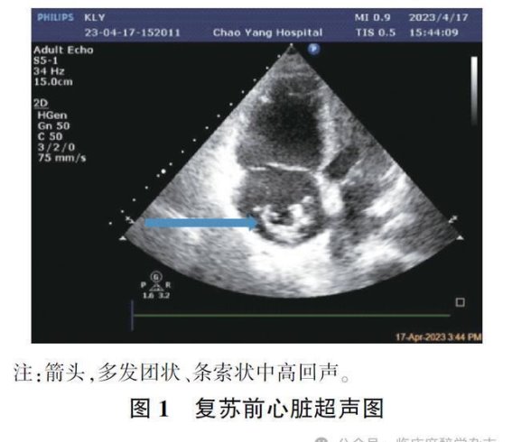 术中急性右心房活动性血栓合并右心衰竭一例