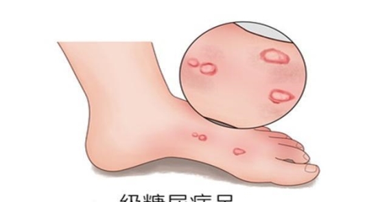 糖尿病的隐秘警钟：脚部健康的警示