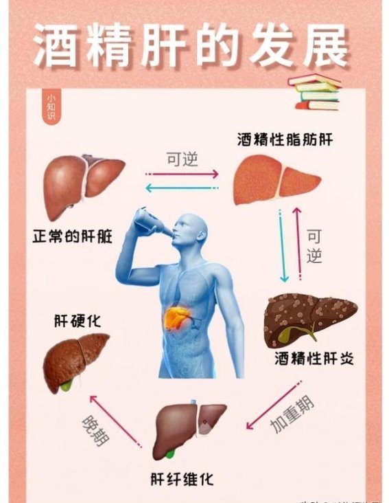 饮酒虽愉快，酒精肝不可小觑——深度解析酒精性肝病