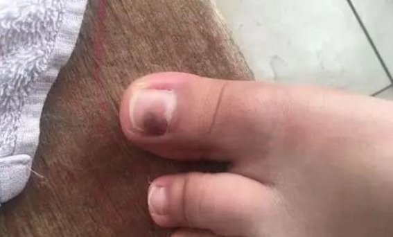 双脚健康暗示全身疾病，医生提醒：脚部4大症状不可忽视