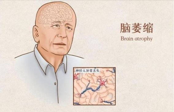 脑萎缩的早期识别与干预：减缓衰退的关键