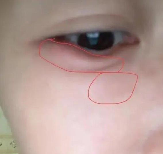 眼睑肿胀竟是肾病的警告，医生这样说
