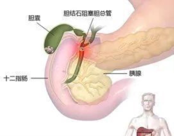 健康的警示：一位年轻人的胆结石故事