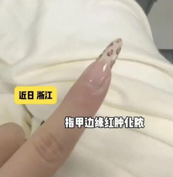 倒刺危机：看似无害的小问题，竟可能引发大麻烦