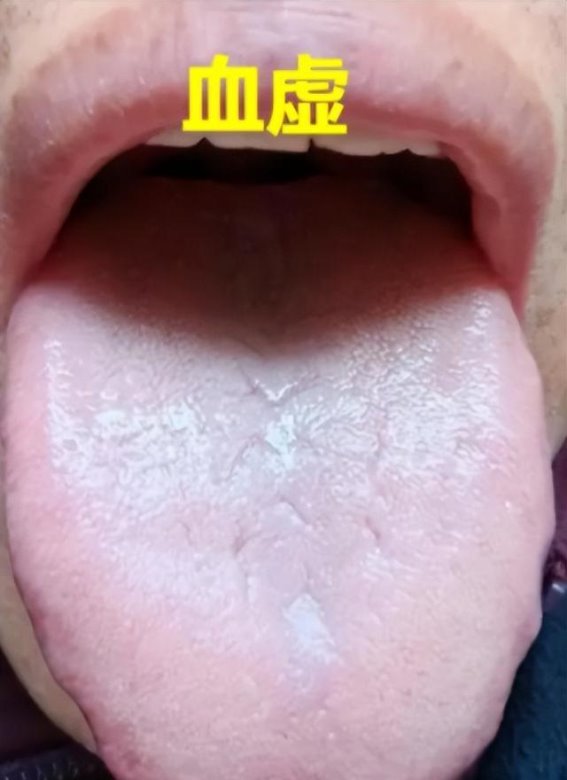 舌裂纹的三大成因及其调理方法