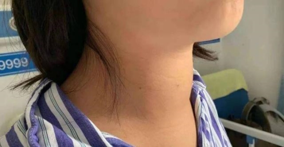 甲状腺不好的人能吃香蕉吗？医生建议：这4类水果要多吃