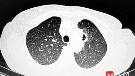 气管镜搭载超声探头：精准定位肺部病变的突破性技术