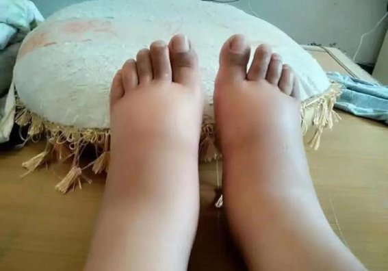 降压药吃不好，肾脏可能早早“告别”！