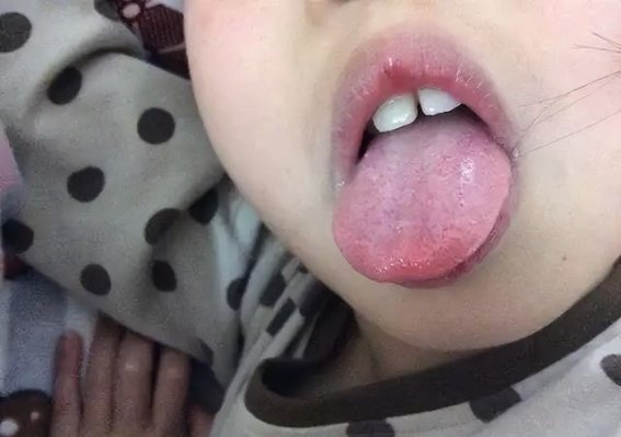 舌头的异常信号：你的血糖失控了吗？