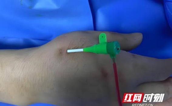 永州市中心医院引入远端桡动脉穿刺技术，开启冠脉介入治疗新篇章