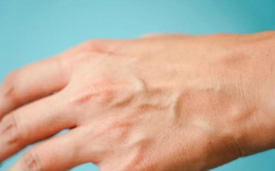青筋凸起的身体信号：正常现象还是健康隐患？