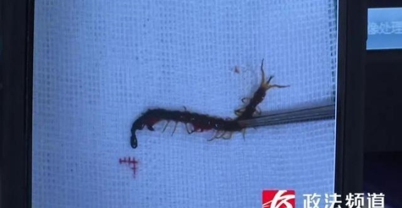 长沙13岁男孩睡梦中疼醒，耳朵里竟有一条活蜈蚣