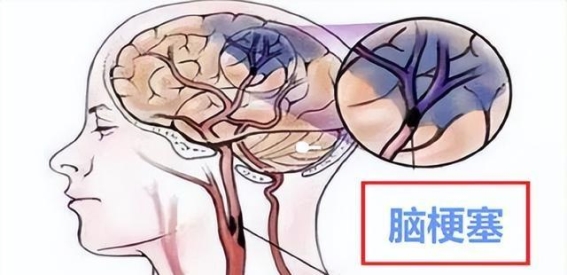 脑梗塞后，如何帮助患者走出康复困境
