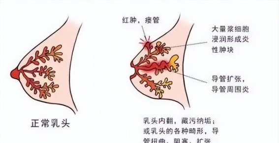 揭秘浆乳与肉芽肿性乳腺炎的五大差异，精准辨识避免误诊