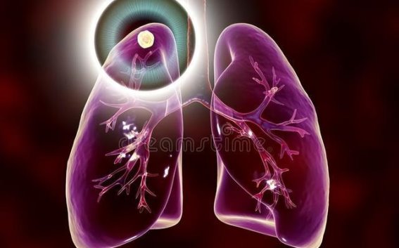 中医视角下肺结节的调理与康复