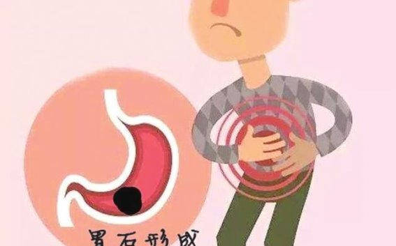 过量食用柿子可能导致胃石，医生提醒适量为宜