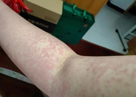 阿司匹林脱敏治疗的临床应用与效果分析