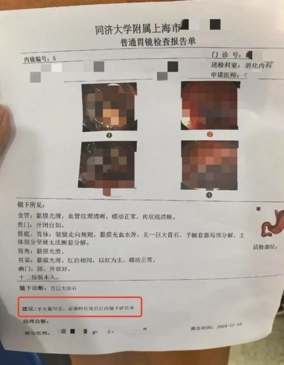 女子食用糖霜山楂引发巨大胃结石，医生建议可乐化解