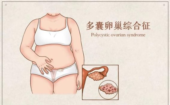 多囊卵巢综合征，豆制品能帮忙吗？