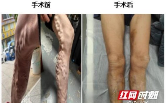 微创介入治疗助力群众健康 永州职院附属医院打造优质医疗服务