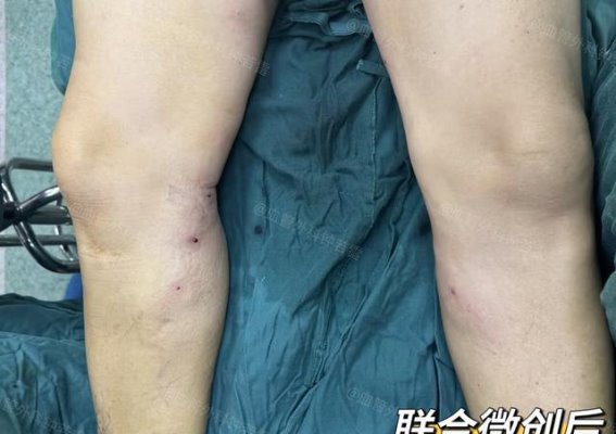 年近50岁，选择武汉微创治疗静脉曲张的亲身经历