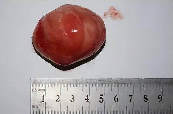 43岁女子乳腺增生疼痛，医生提醒避免三种食物