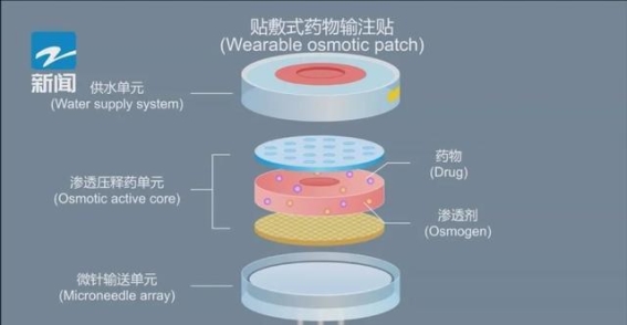 浙江大学“无线”输液技术革新：无痛、精准的医疗新方案