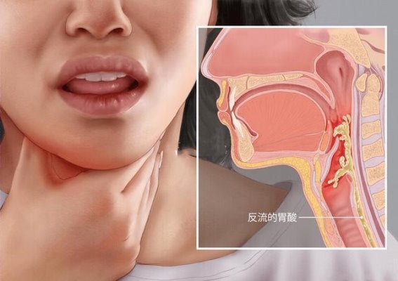 咽喉反流症状频现？医生提醒：小心病根在胃