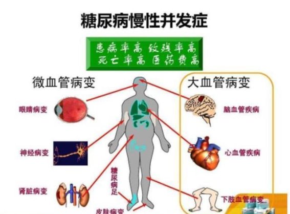 老年糖尿病防控指南：在“盛糖时代”的应对策略