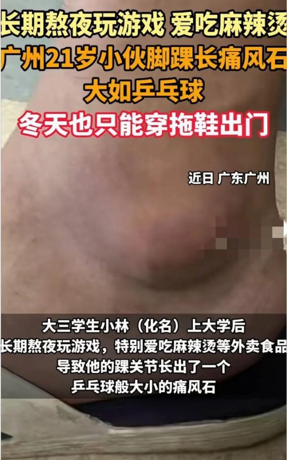 21岁年轻小伙脚踝现乒乓球大小痛风石，痛风悄然侵袭年轻人
