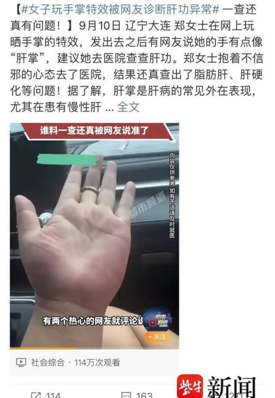 手掌的秘密：如何通过手掌变化警惕肝病